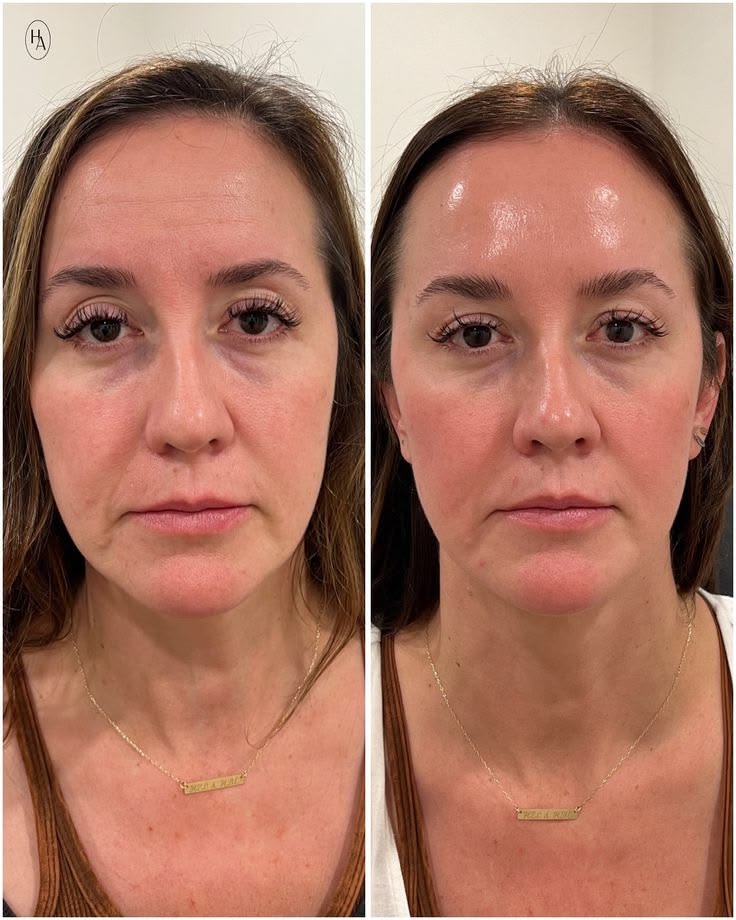 Antes y después visual de líneas de expresión en rostro