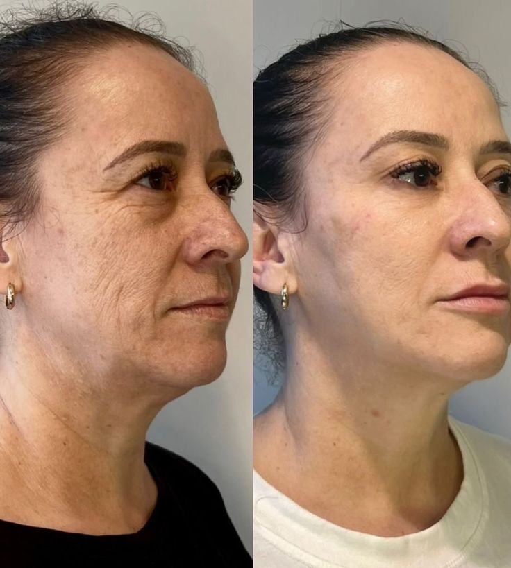 Antes y después visual de líneas alrededor de ojos y mejilla